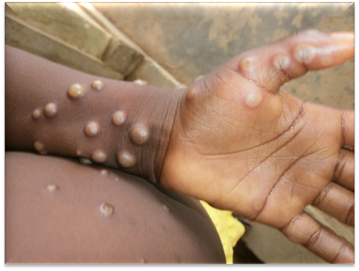 WHO For Monkeypox:डब्ल्यूएचओ ने कहा-मंकीपॉक्स अभी भी एक अंतरराष्ट्रीय स्वास्थ्य आपातकाल

