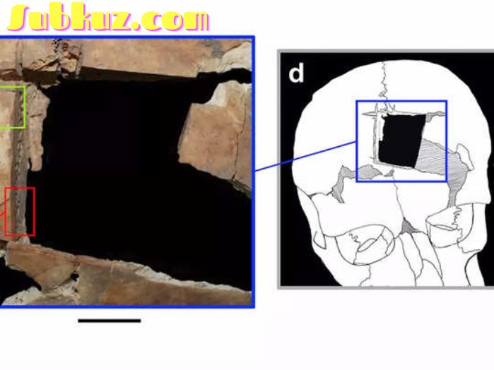  3500 साल पुरानी इंसानी खोपड़ी में चौकोर छेद का रहस्य सुलझा, कारण जान पुरातात्विक भी रह गए दंग