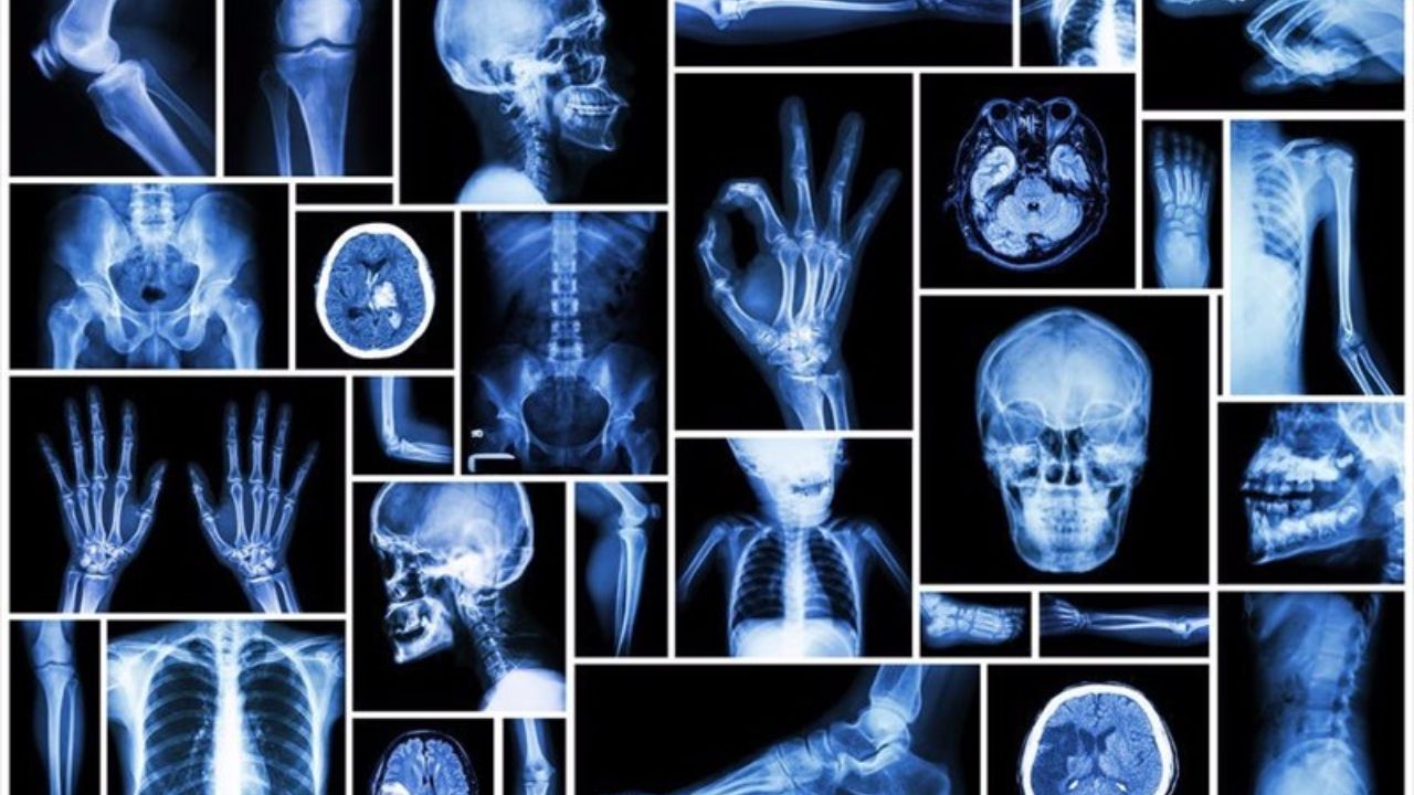 x -rays क्या है? जानें इससे  जुड़े महत्वपूर्ण रोचक तथ्य, क्या है इसकी किरणे हानिकारक ?