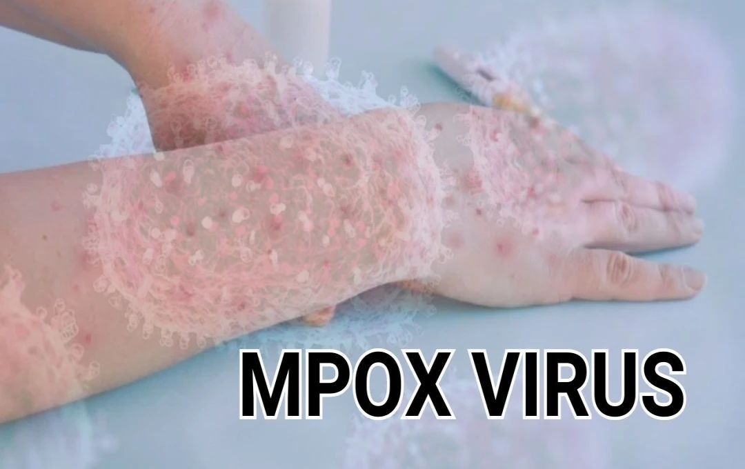 MPOX: दुनिया में MPOX Virus का खौफ, WHO ने जारी की एडवाइजरी, हवाई अड्डों पर बढ़ाई सतर्कता   