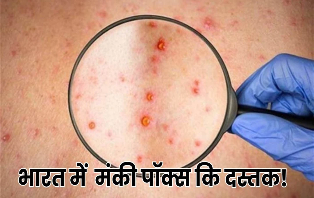 Mpox Virus: सावधान! Monkeypox Virus ने भारत में दी दस्तक, जानें कितना खतरनाक हैं यह वायरस, क्या है इसके लक्षण और उपाय? 