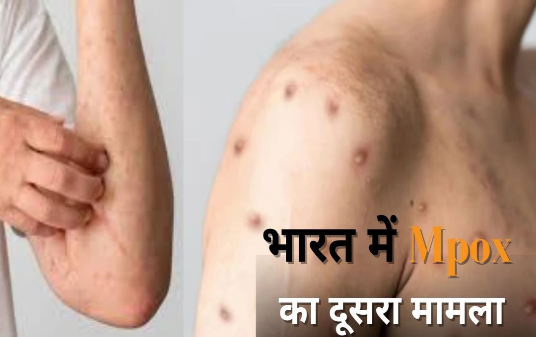 Mpox: भारत में Mpox का दूसरा मामला, एमपॉक्स कोरोना से कितना है खतरनाक? जानें मंकिपॉक्स और कोविद-19 में अंतर् 