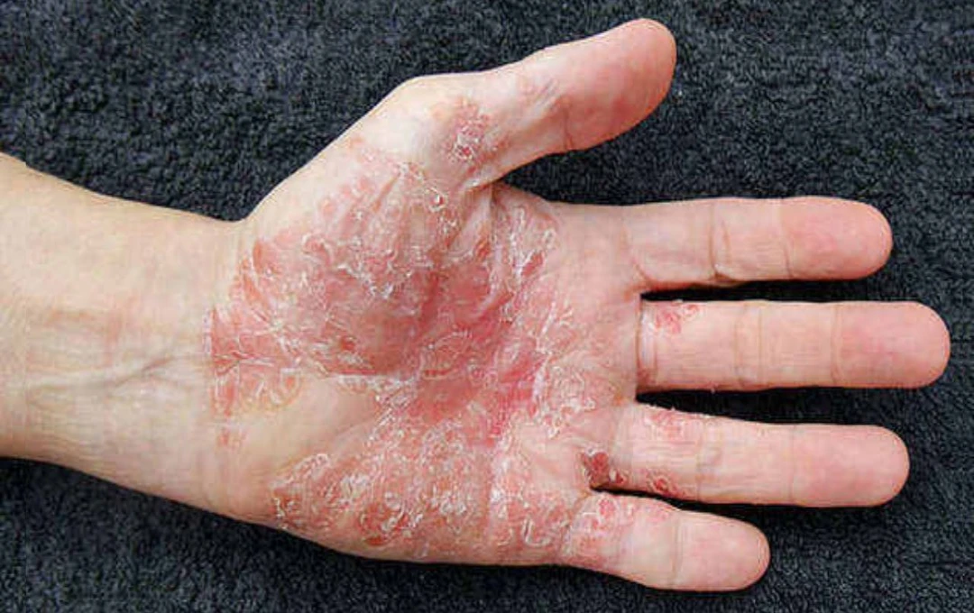 12 Home Remedies and Prevention Tips for Psoriasis