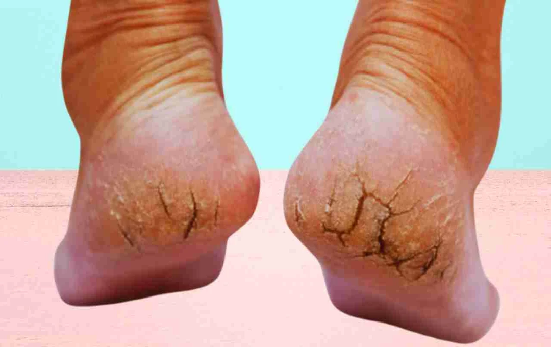5 Ayurvedic Home Remedies for Cracked Heels