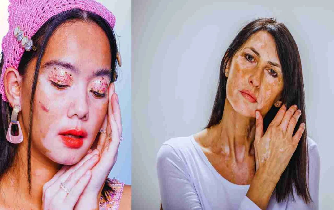 World Vitiligo Day 2025: समय रहते पहचानें सफेद दाग के संकेत, जानें कारण, लक्षण और इलाज की सटीक जानकारी