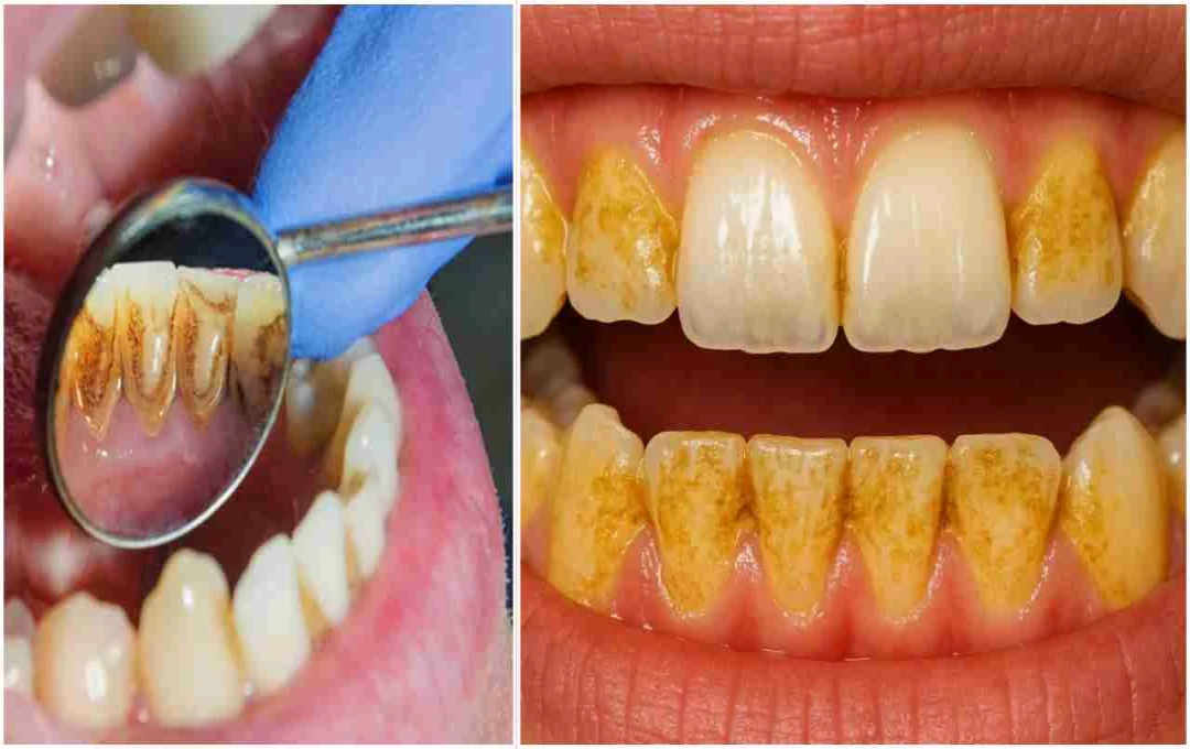 Get Pearly White Teeth: Effective Home Remedies to Remove Plaque and Stains