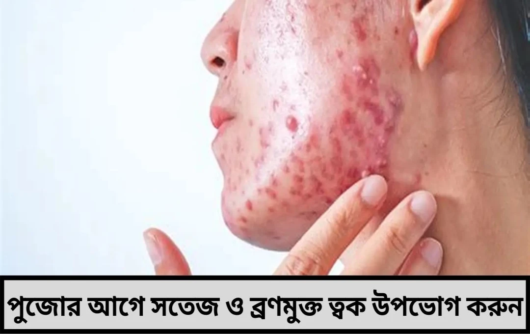 পুজোর আগে ব্রণ মুক্ত মুখের জন্য ৫টি কার্যকর টিপস