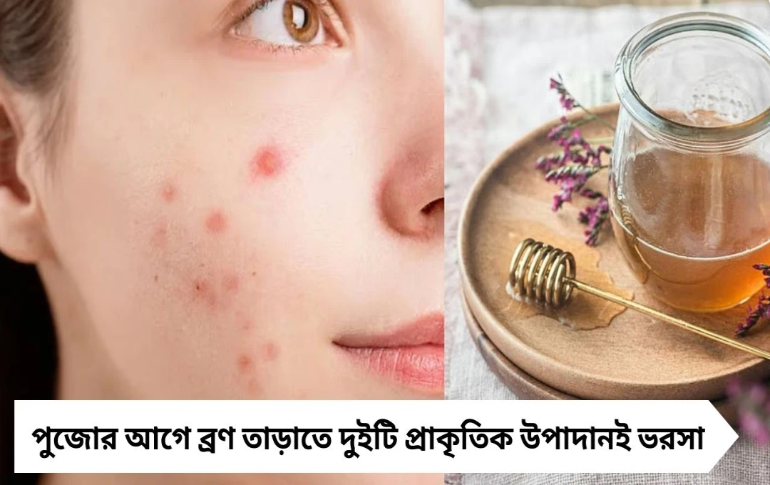 পুজোর আগে ব্রণ তাড়াতে দুইটি প্রাকৃতিক উপাদানই ভরসা: দারুচিনি ও মধু