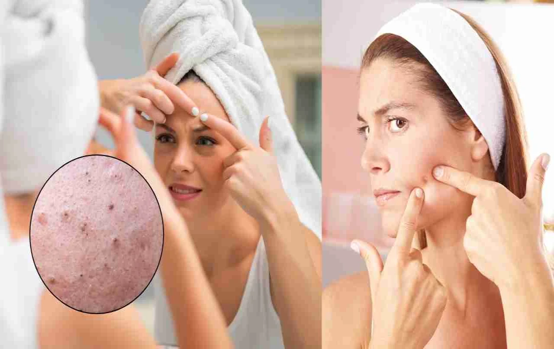 মুখে ব্রণ: কারণ, প্রতিরোধ ও সুস্থ থাকার উপায়