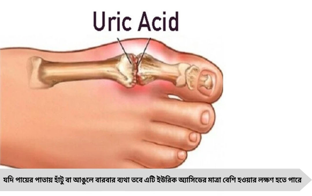 ইউরিক অ্যাসিড বাড়ছে? কারণ, লক্ষণ ও নিয়ন্ত্রণের সহজ উপায়