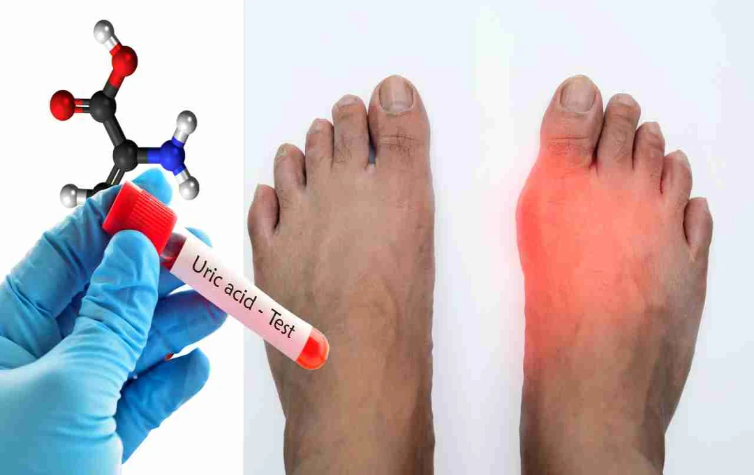 यूरिक एसिड बढ़ना बना आम समस्या, जानिए क्या हैं इसके लक्षण और कैसे रखें नियंत्रण