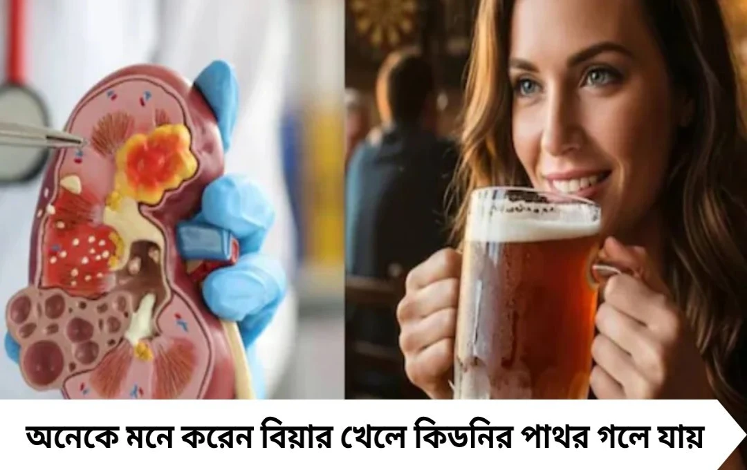 Beer & Kidney Stone: বিয়ার খেলে গলবে কিডনির পাথর? ডাক্তার জানালেন আসল সত্য
