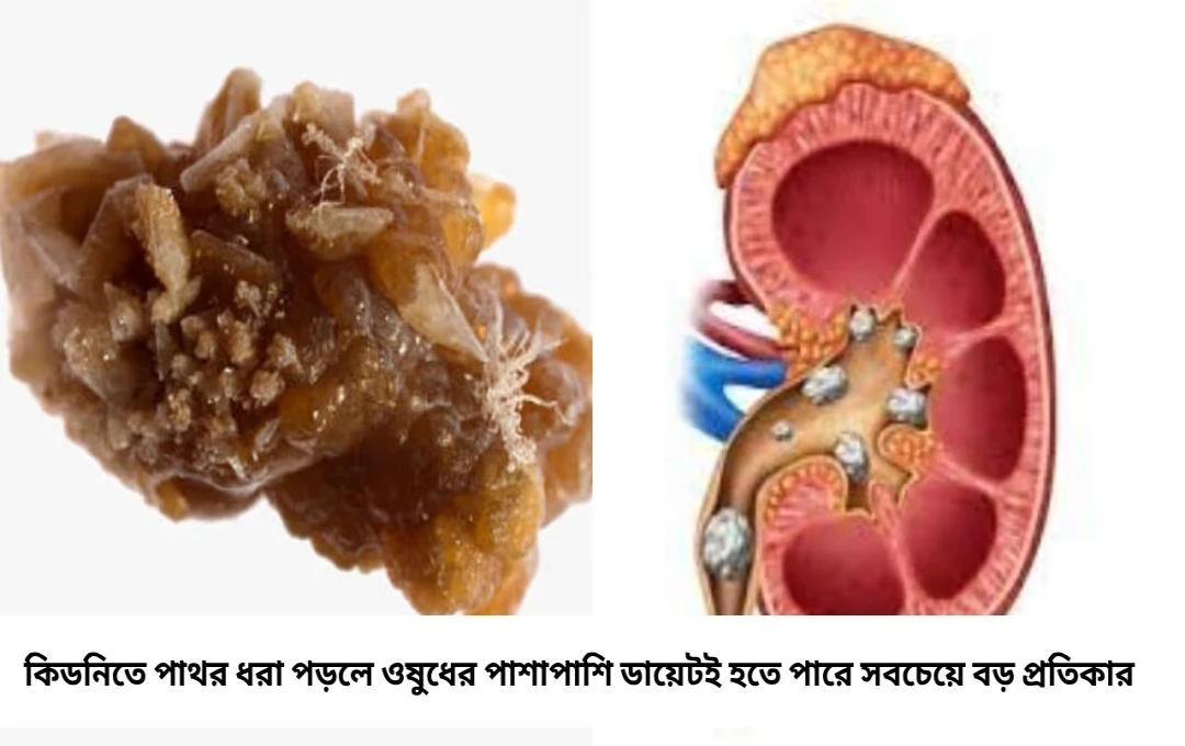 ডায়েটে সামান্য পরিবর্তনেই দূরে থাকবে কিডনির পাথর, জানুন বিশেষজ্ঞদের পরামর্শ
