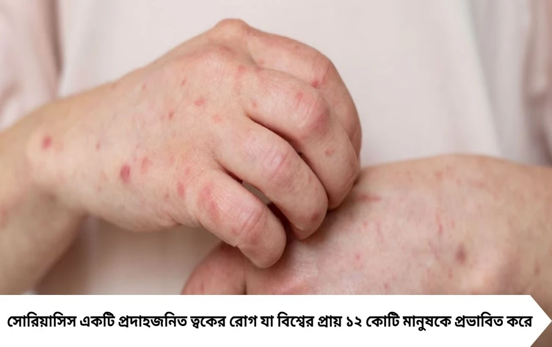Psoriasis: ভয়ঙ্কর ত্বকের অসুখ ‘সোরিয়াসিস’, কোন খাবারে বাড়ে ঝুঁকি? জানুন বিশেষজ্ঞদের মত