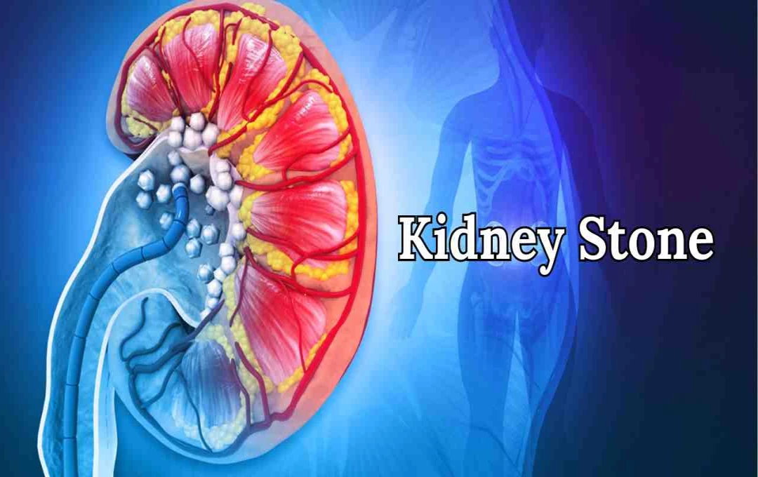 Kidney Stone: जाने इसके तीन प्रमुख कारण और बचाव के तरीके