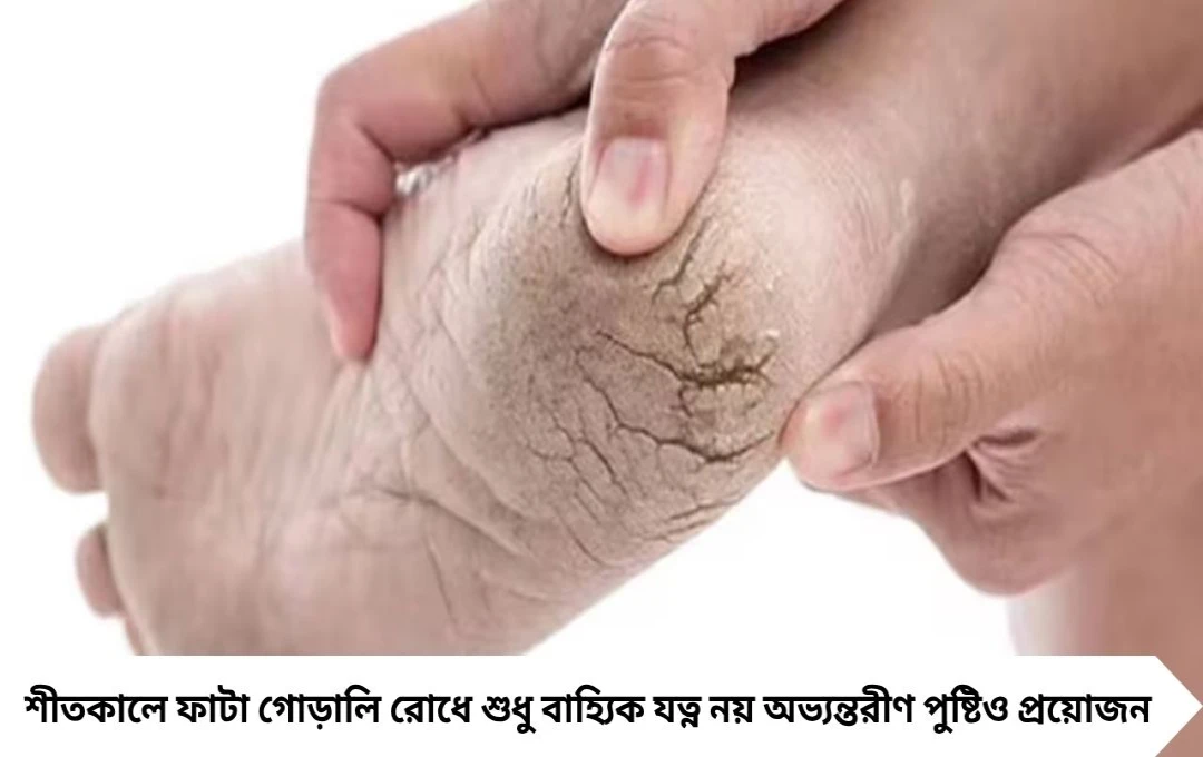 ভিটামিনের ঘাটতিতে ফাটছে গোড়ালি! জানুন কোন খাবারে মিলবে সমাধান