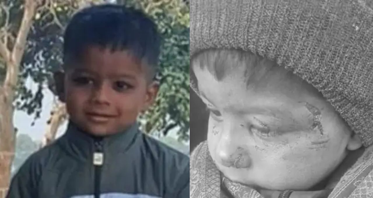 तीन रैबीज इंजेक्शन बेअसर, आगरा में पागल कुत्ते के काटने से 5 वर्षीय बच्चे की मौत