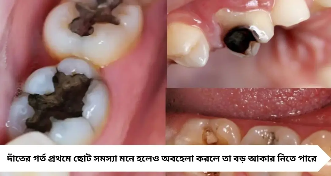 Tooth Cavity: সরষের তেলে এক চিমটি লবণ! দাঁতের কালো গর্তে লাগালেই মিলতে পারে আরাম, বলছেন বিশেষজ্ঞ