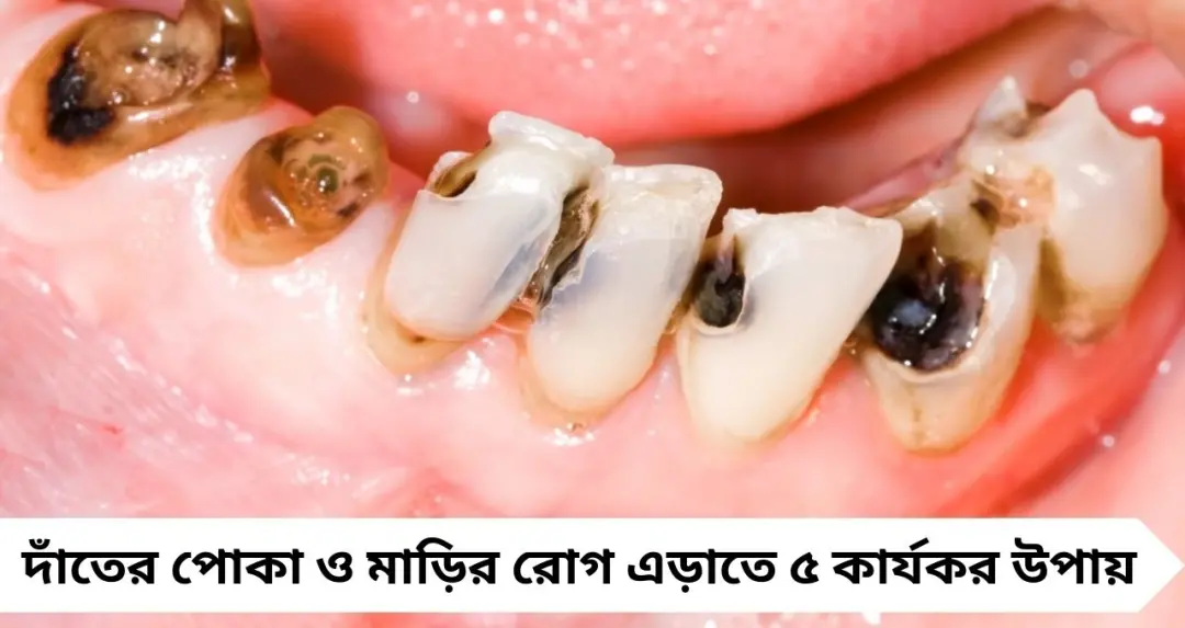 ডেন্টাল সমস্যায় ‘পঞ্চবাণ’ সমাধান! পোকা-কালো গর্ত দূরে রাখবে ৫ সহজ অভ্যাস
