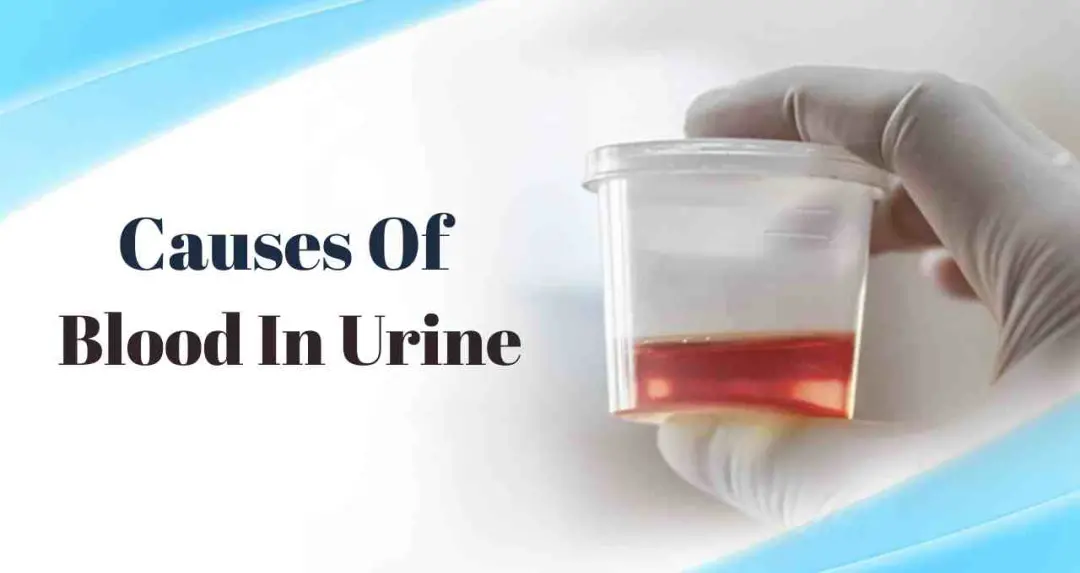 क्या पेशाब में खून आना किडनी की बीमारी का संकेत है? जानें संभावित वजहें