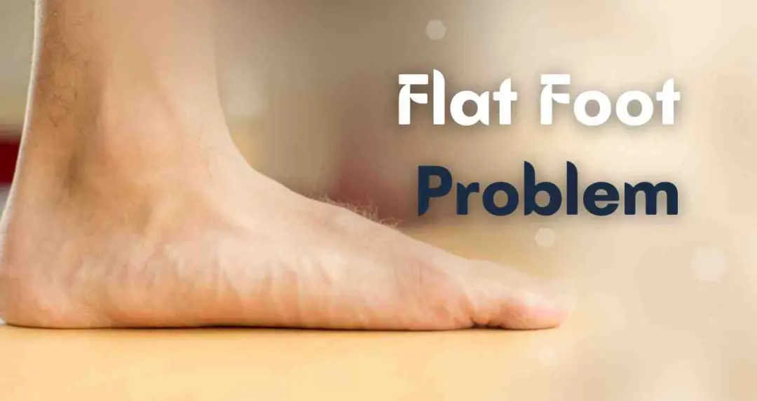 पैरों का आर्च क्यों हो जाता है खत्म? समझिए फ्लैट फुट की समस्या