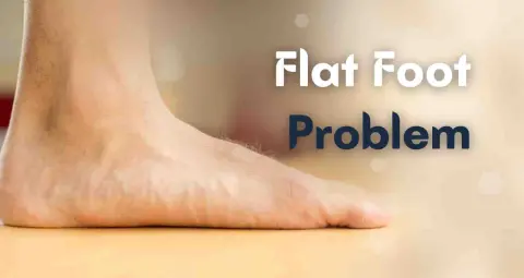 पैरों का आर्च क्यों हो जाता है खत्म? समझिए फ्लैट फुट की समस्या