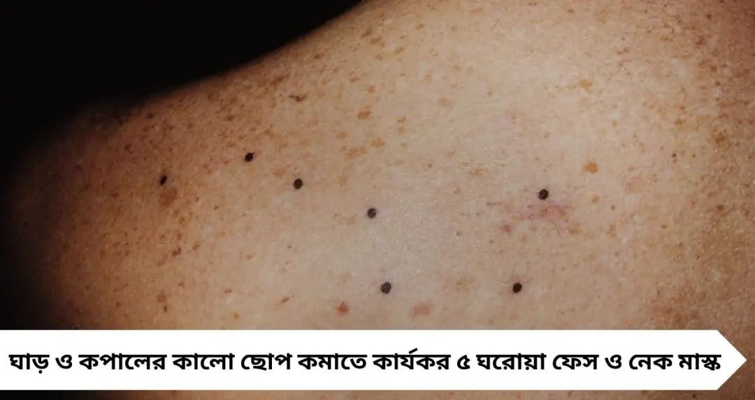 ঘাড়ে-কপালে কালো ছোপ? পার্লার ছাড়াই ৫ ঘরোয়া মাস্কে ফিরতে পারে উজ্জ্বলতা
