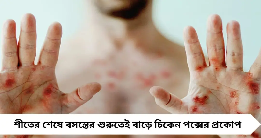 চিকেন পক্সের আতঙ্ক বাড়ে বসন্তে! এই ৪ সবজি খেলেই বাড়বে রোগ প্রতিরোধ ক্ষমতা
