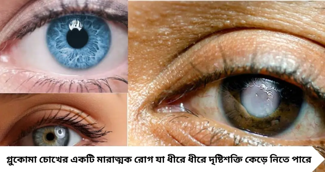 চোখের ‘নীরব চোর’ গ্লুকোমা! উইপোকার মতো কুরে কুরে নষ্ট করে দৃষ্টি—লক্ষণ, কারণ ও চিকিৎসা জানুন