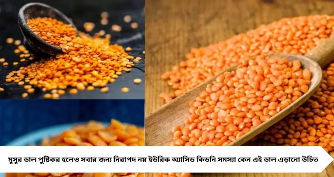 মুসুর ডাল খেলেই বিপদ! উপকারী হলেও এই ৫ সমস্যায় ভুগলে দূরে থাকুন, নইলে বাড়বে রোগের ঝুঁকি
