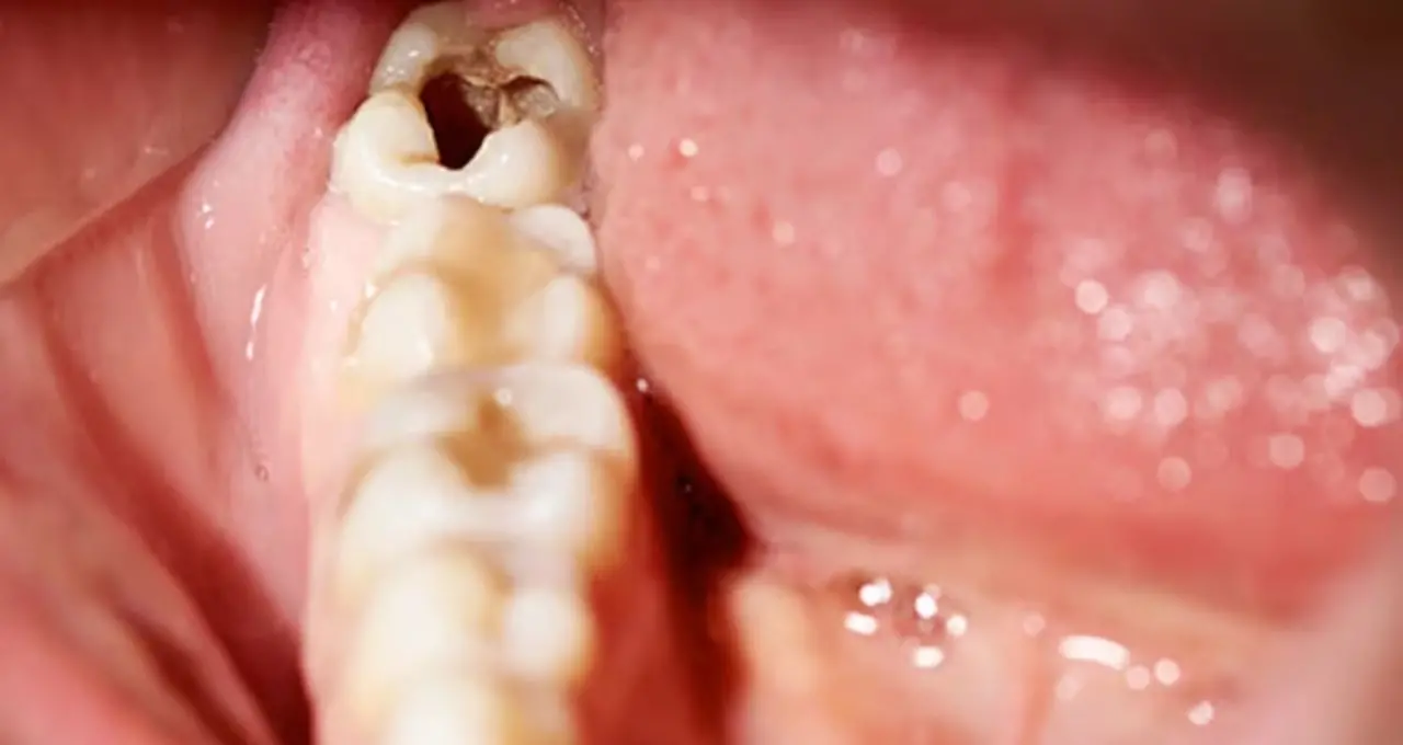 Tooth Cavity Remedies: দাঁতে পোকা ও গর্তে কাঁদছেন? ডিমের খোলাতেই মিলতে পারে স্বস্তি, সঙ্গে আরও ৫ ঘরোয়া টোটকা!
