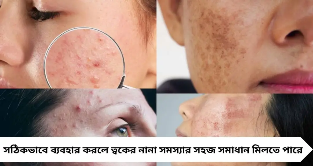 ব্রণ-মেছতা উধাও! রান্নাঘরের এই ছোট্ট মশলাই ফিরিয়ে দেবে উজ্জ্বল ত্বক
