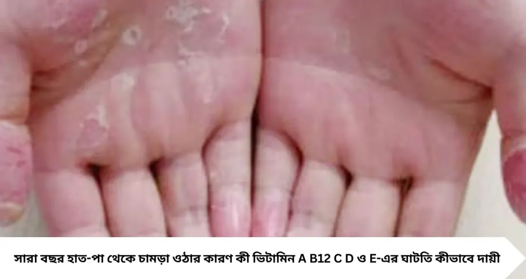 সারাবছর হাত-পা থেকে চামড়া উঠছে? ভিটামিনের ঘাটতির ইঙ্গিত! কোন খাবারে মিলবে সমাধান

