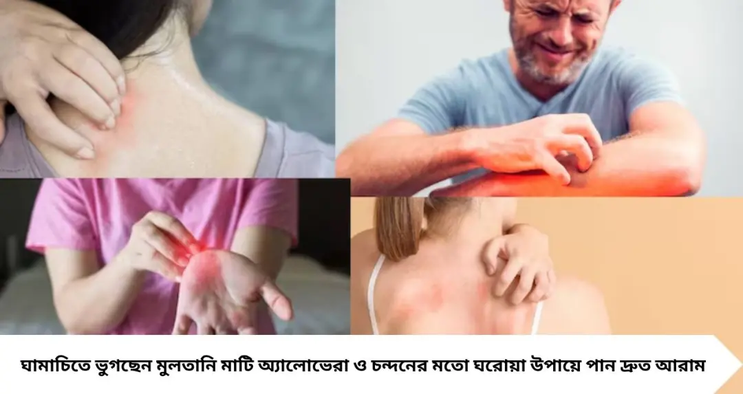 ঘামাচিতে আর জ্বালা নয়! ট্যালকম পাউডার ছাড়াই মুলতানি মাটির ঠান্ডা ছোঁয়ায় মিলবে তাত্ক্ষণিক আরাম
