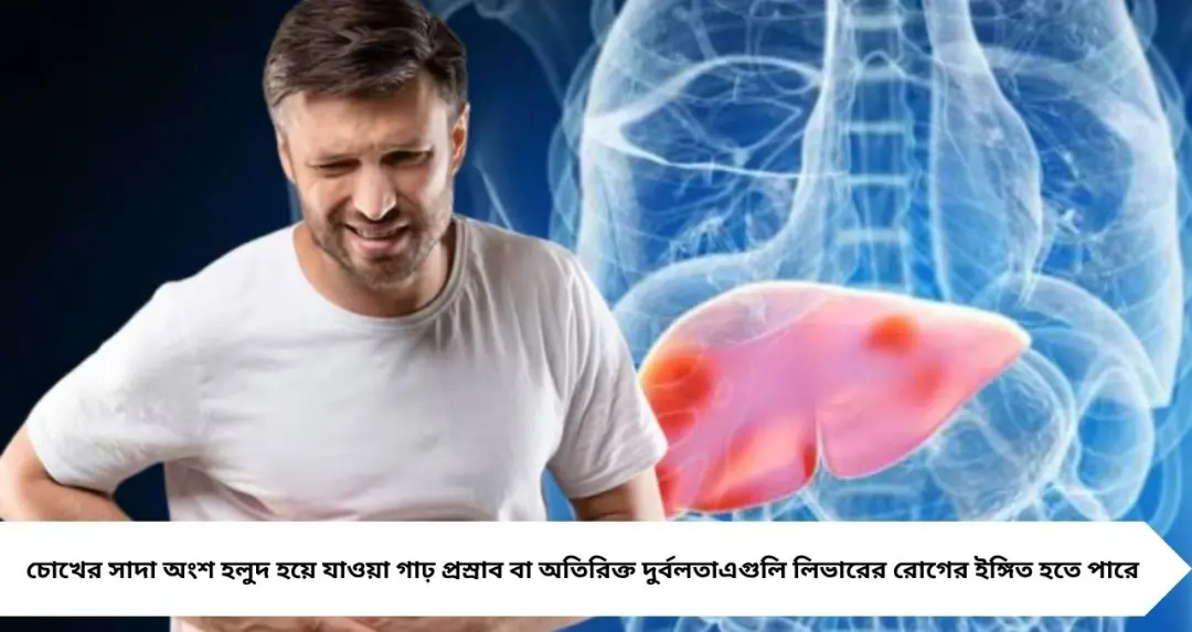 চোখ হলুদ? প্রস্রাব গাঢ়? শরীর দিচ্ছে ভয়ঙ্কর ইঙ্গিত! হতে পারে লিভারের মারাত্মক রোগের লক্ষণ