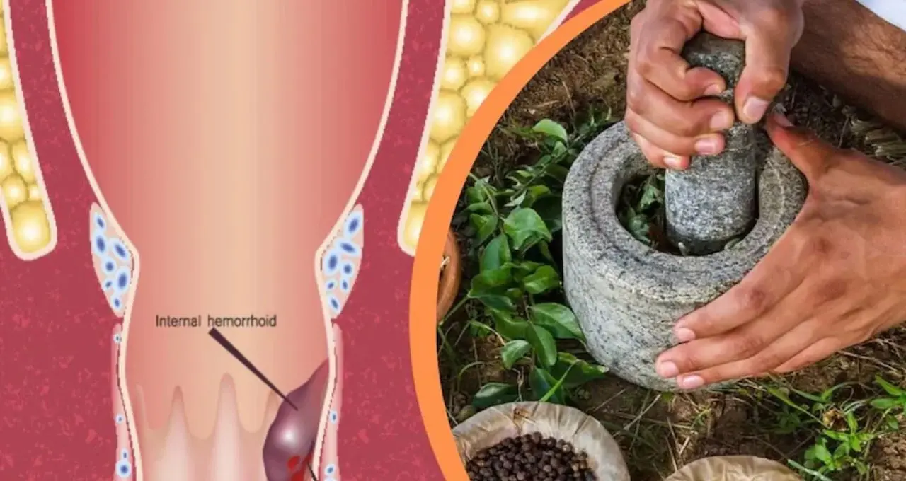 Piles Remedy: এই ৩ খাবার খেলেই বাড়তে পারে অর্শের যন্ত্রণা! রক্তপাত-জ্বালায় আরাম দিতে পারে ত্রিফলা ও আমলকির খোসা
