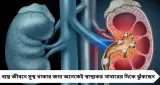 কিডনিতে পাথরের ঝুঁকি বাড়াচ্ছে রোজকার খাবার! ভুলেও অতিরিক্ত খাবেন না এই ৬ খাদ্য, সতর্ক করলেন বিশেষজ্ঞরা
