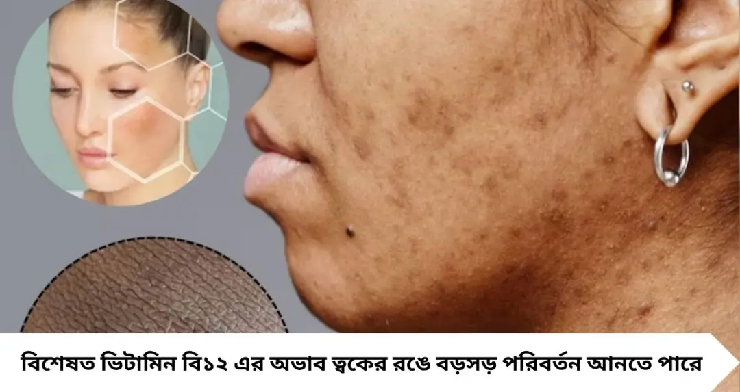 কোন ভিটামিনের অভাবে ত্বকে বাড়ে পিগমেন্টেশন? মুখে কালো ছোপের নেপথ্যে লুকিয়ে থাকতে পারে এই পুষ্টির ঘাটতি