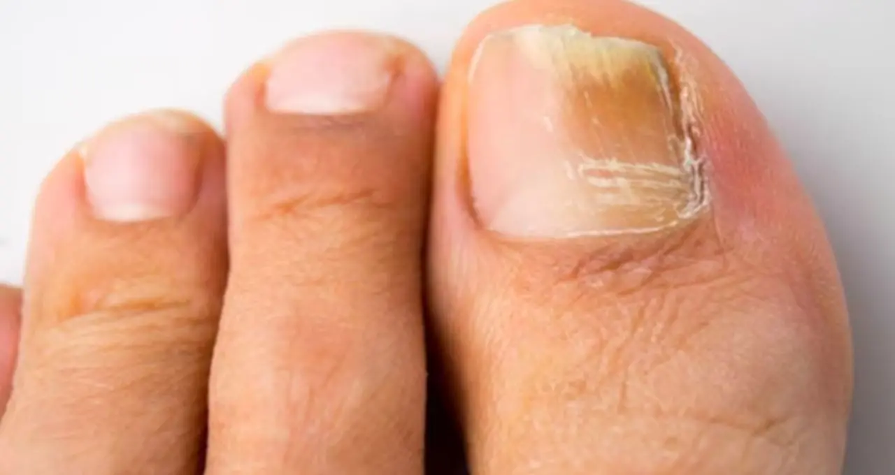 Nail Infection in Monsoon: বর্ষায় নখকুনির যন্ত্রণা? ভিনিগারের সহজ টোটকায় মিলতে পারে স্বস্তি, তবে জেনে নিন চিকিৎসকদের গুরুত্বপূর্ণ পরামর্শ