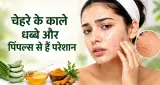 Skincare Tips: चेहरे के काले धब्बे और पिंपल्स से हैं परेशान? जानिए डॉक्टर द्वारा बताए गए असरदार उपाय