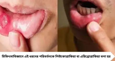 Mouth Ulcer & Oral Cancer: মুখের ঘা ২ সপ্তাহেও সারছে না? সাধারণ আলসার নাকি ওরাল ক্যানসারের সতর্ক সংকেত, চিনুন লক্ষণ
