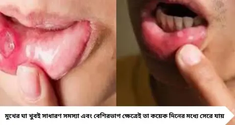 Mouth Ulcer & Oral Cancer: ২ সপ্তাহেও মুখের ঘা সারছে না? সাধারণ আলসার নাকি সতর্ক সংকেত, জেনে নিন লক্ষণগুলি
